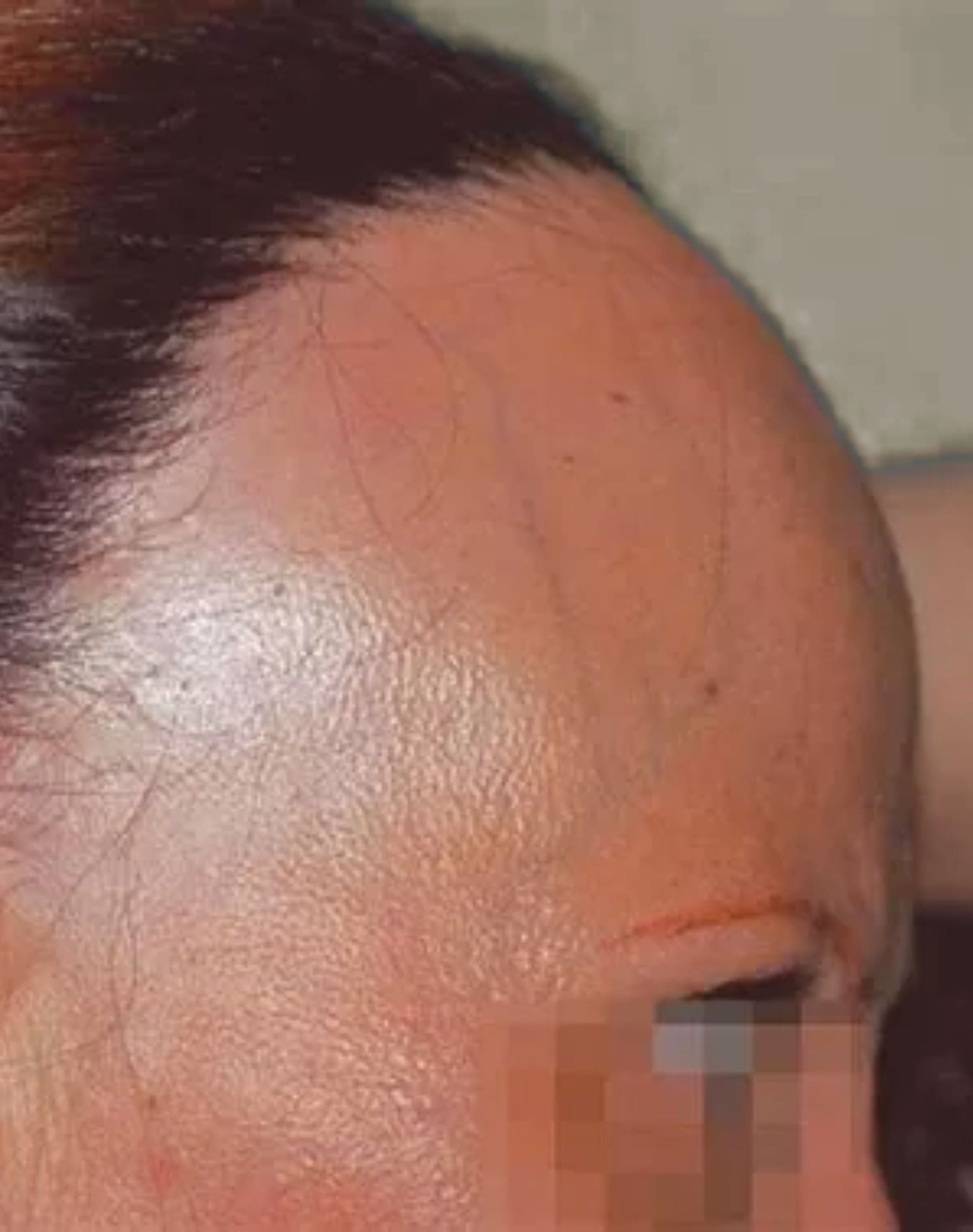 Frontal Fibrosante: o que é, principais sinais e quando buscar ajuda