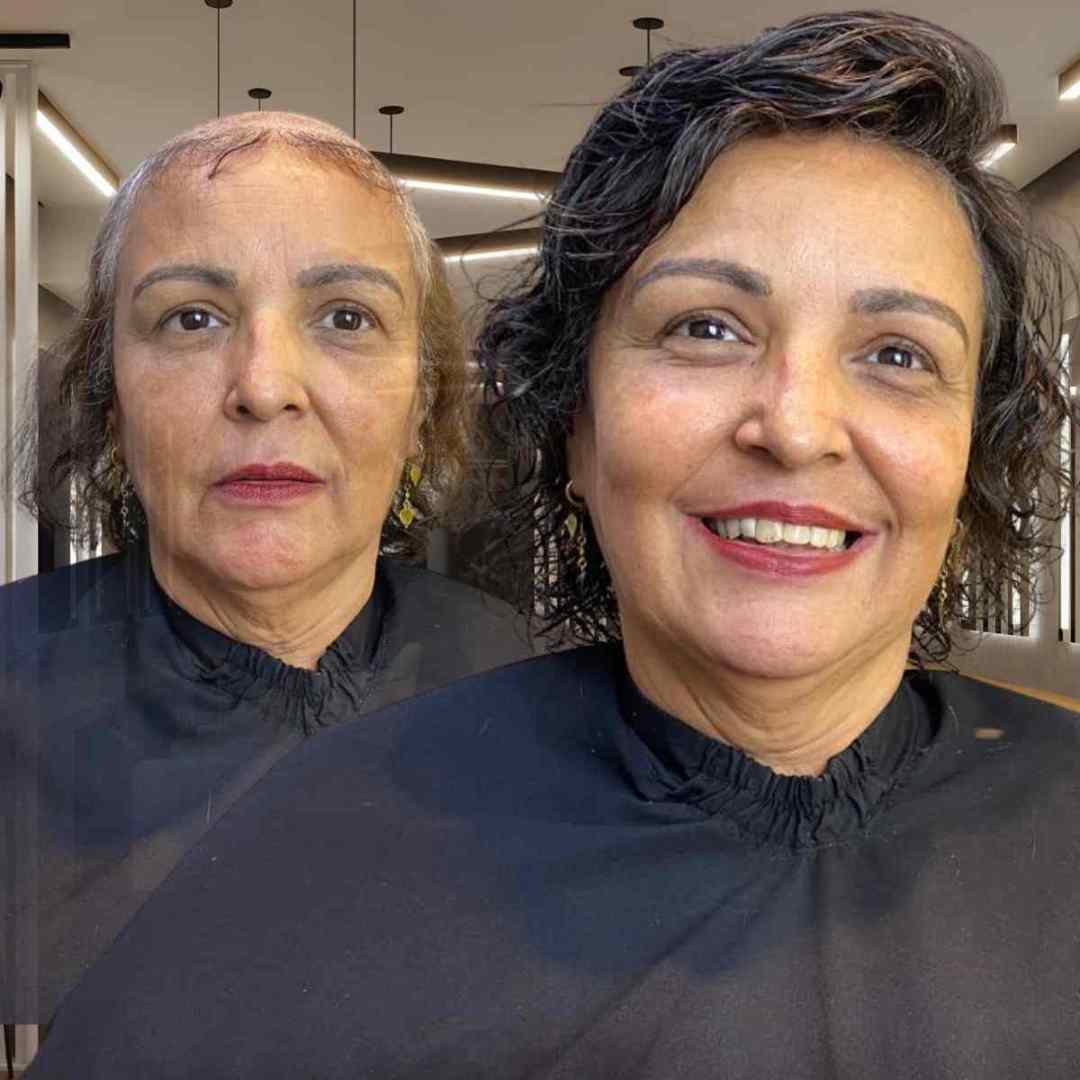 Prótese Capilar Personalizada – Pronta para Uso Imediato em Todo o Brasil