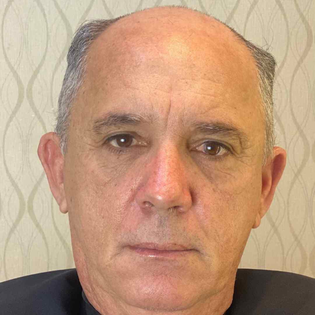 Prótese Capilar Personalizada – Pronta para Uso Imediato em Todo o Brasil